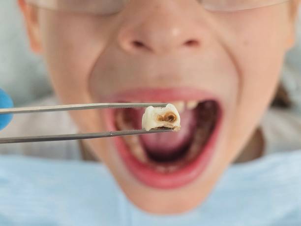 Best Emergency Dentist for Knocked-Out Tooth in Schoolcraft, MI